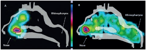 Figure 4: Radioactive deposition of fluticasone in the VCU model with Flixonase® nasal spray (A), and Flixotide® RetroNose prototype device (B).